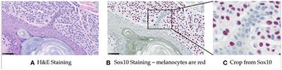 Automated analysis of whole slide digital skin biopsy images